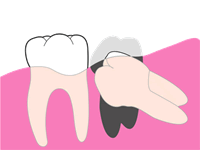 歯科口腔外科：親知らず 抜歯